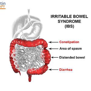 Overcome IBS MP3