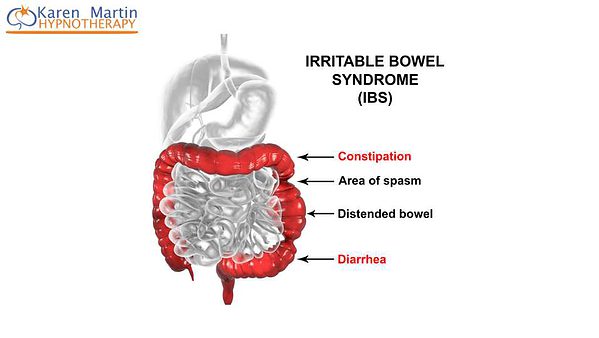 Overcome IBS MP3